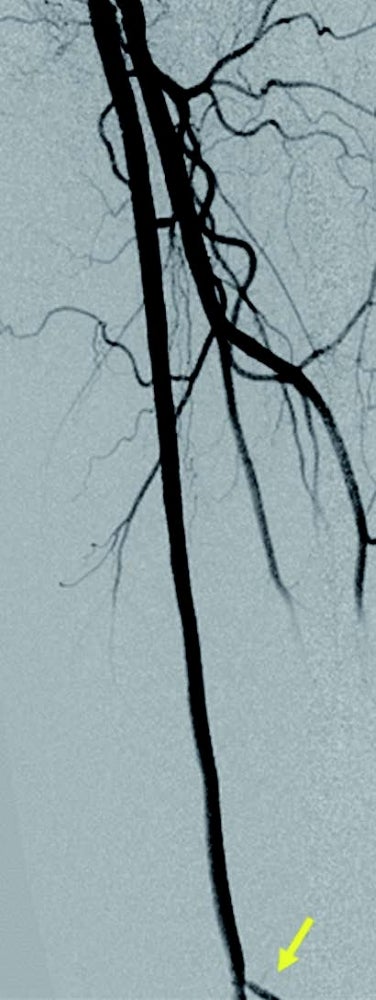 図2 術後造影画像 (Lt.SFA)