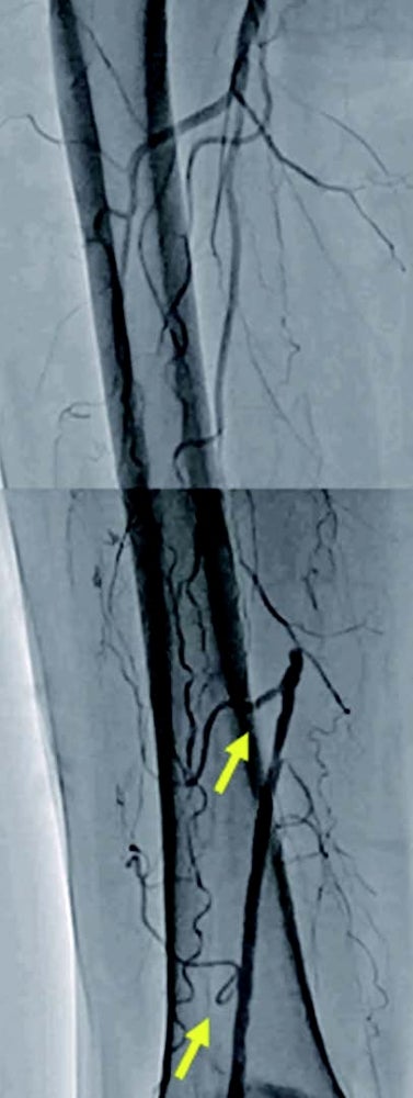 図3 術前造影画像 (Rt.SFA)