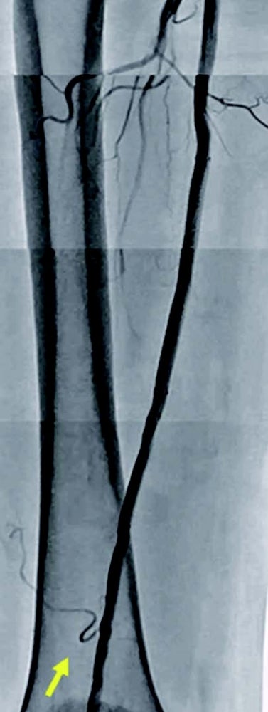 図4 術後造影画像 (Rt.SFA)