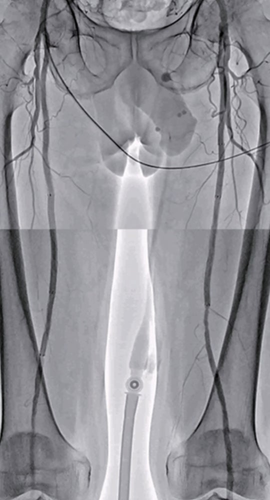 図5 術後３年時フォローアップ造影 (Bil.SFA) ABI : right 1.05 left : 1.05