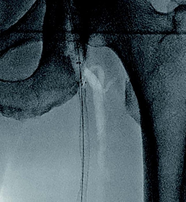 図2 バイアバーン ® ステントグラフト径6.0/長250 mmを留置