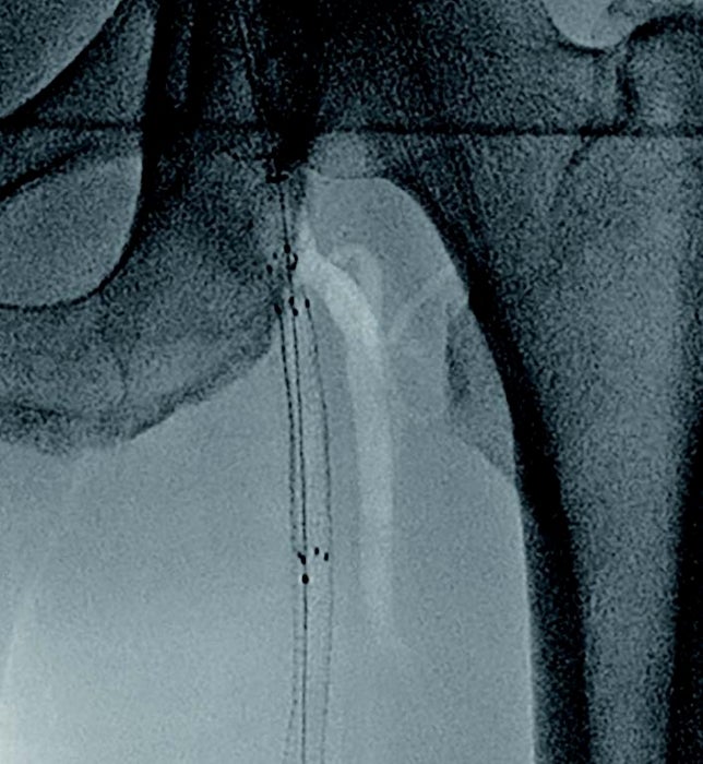 図 4 術中 SFA 起始部バイアバーン ® ステントグラフト 径6.0/長50 mmを追加留置