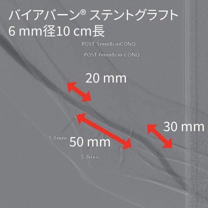図2 バイアバーン ® ステントグラフト留置後