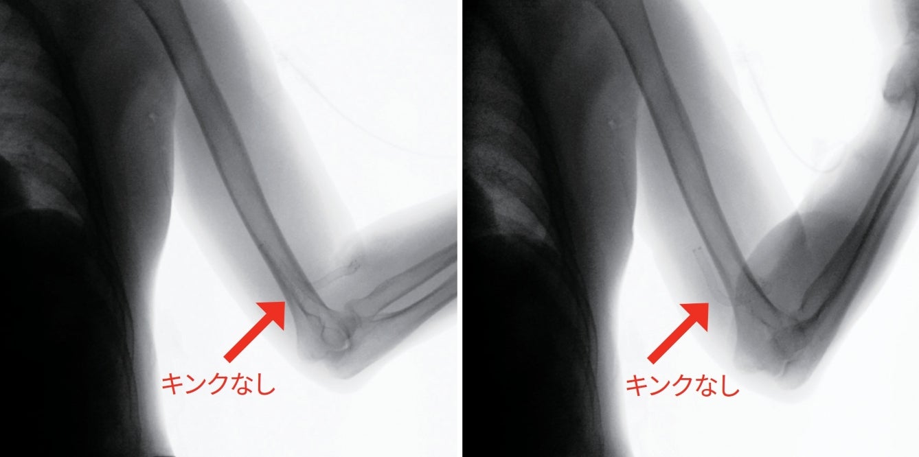 図3 肘部屈曲の確認