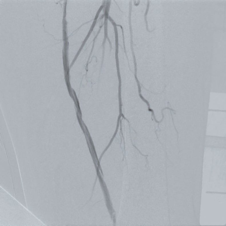 図2 前拡張後 病変部