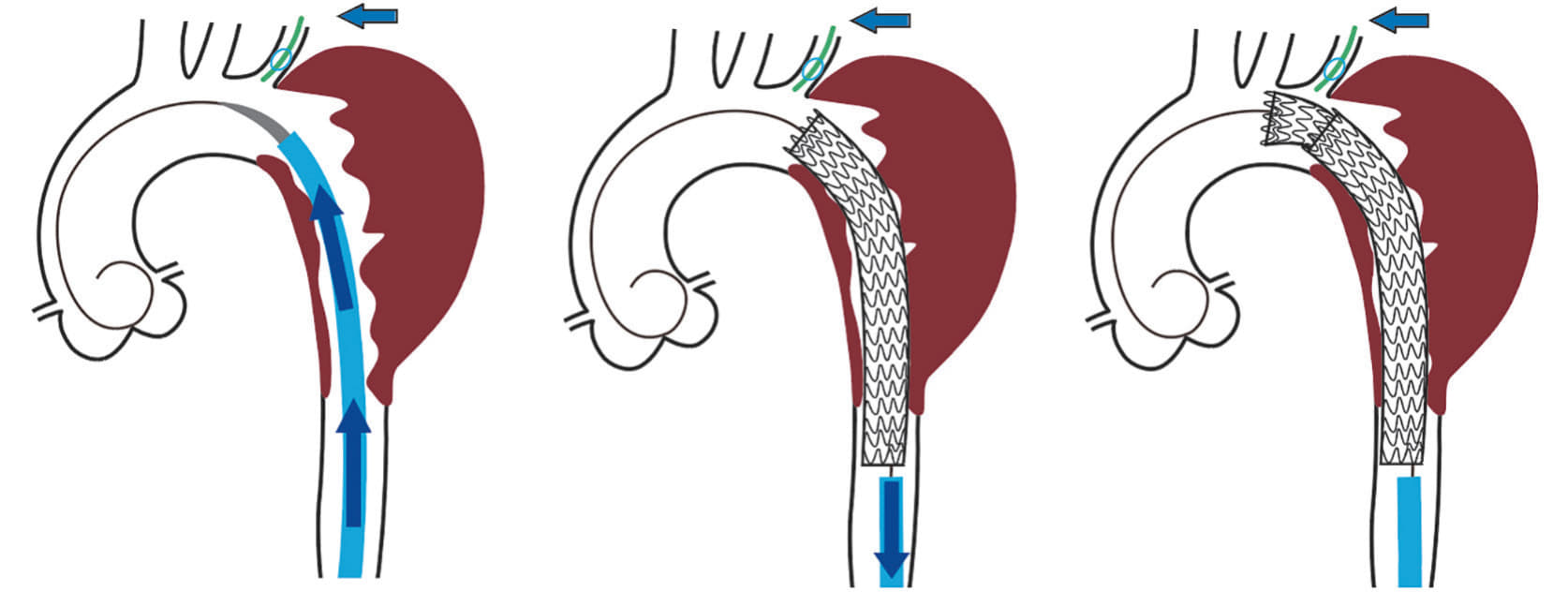 図1 Minimal manipulation approach