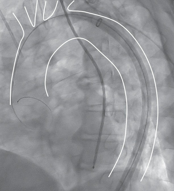 図3a 65 cmドライシール フレックス イントロデューサシースを大動脈頂部まで挿入