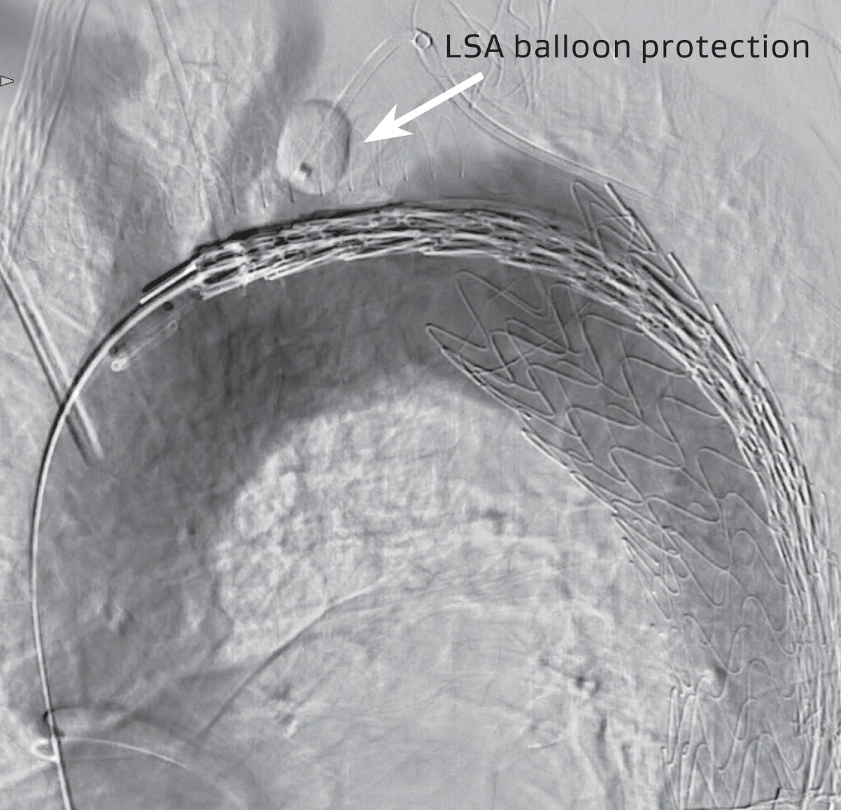図5a 展開前：左鎖骨下動脈（LSA）バルーンプロテクションに2本目の TAG® コンフォーマブル ステントグラフトをZone 2で展開