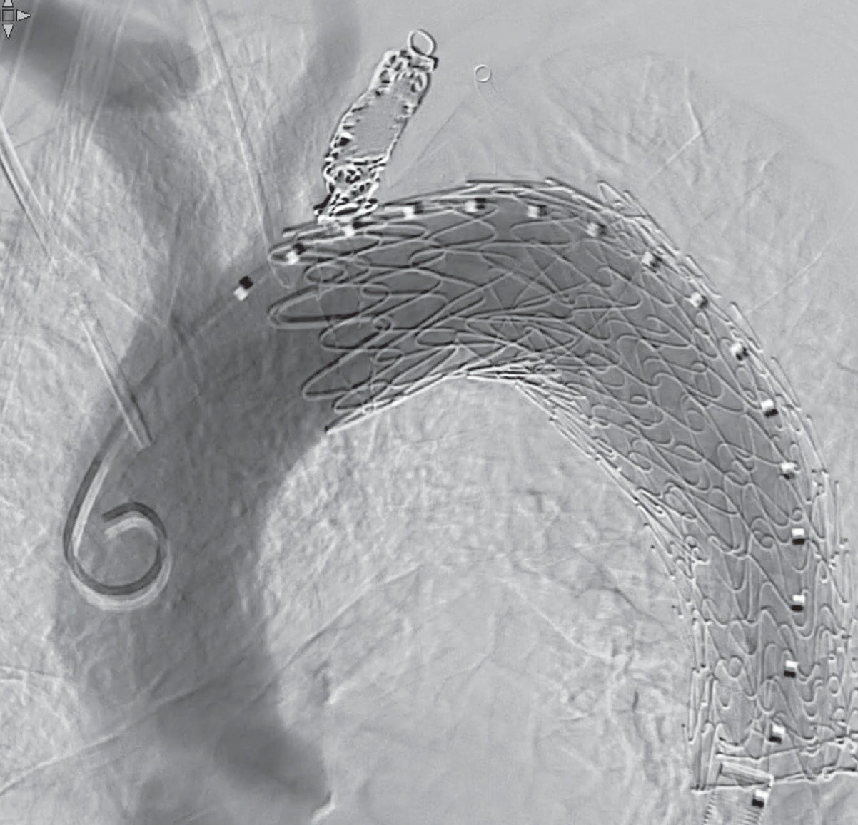 図5b 展開後：最終造影。エンドリークおよびBird beakなし