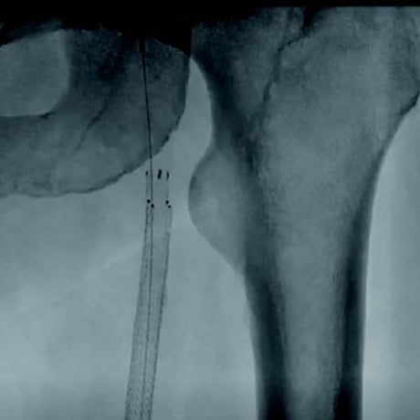 図1 ステントグラフト留置中枢側