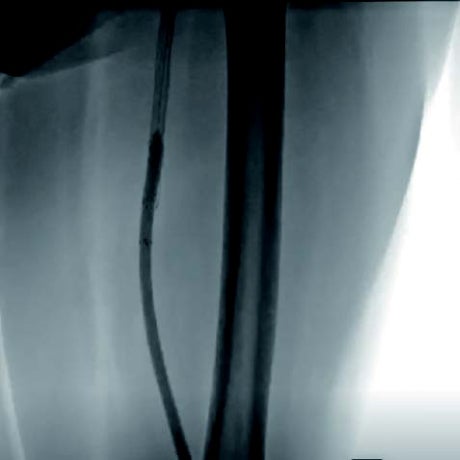 図2 末梢側後拡張　