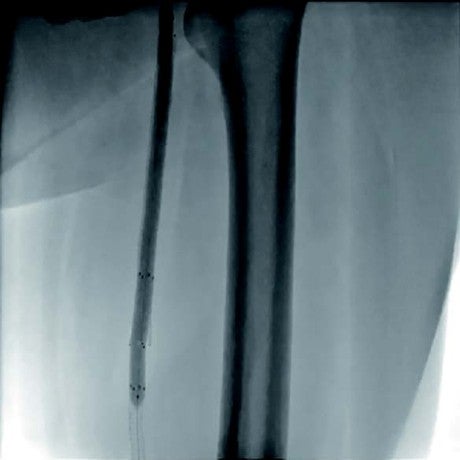 図3 中枢側後拡張