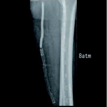 図1 初回ベアステント留置後