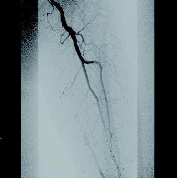 図2 ステント内閉塞