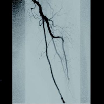 図3 ステントグラフト治療後