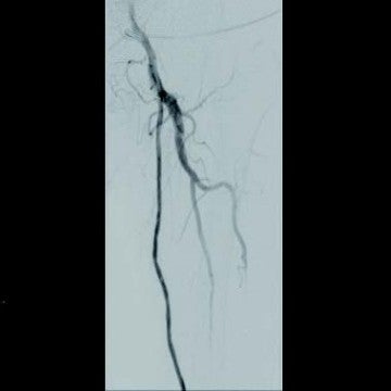図4-1 ISO治療後6年目（大腿）