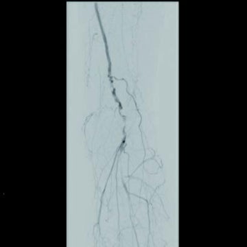 図4-2 ISO治療後6年目（膝窩）