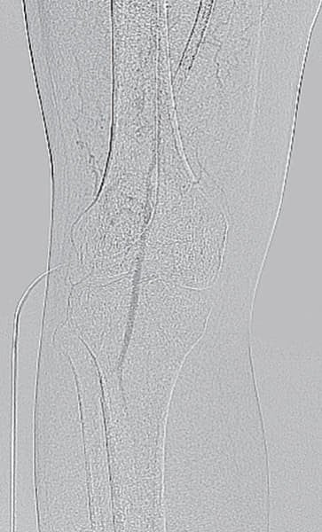 図1 膝窩部・術前