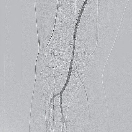 図8 膝窩部・術後