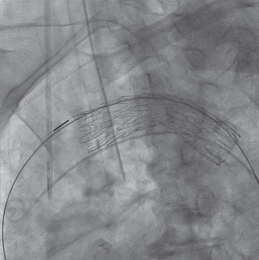 一次展開後のアンギュレーションコントロール
