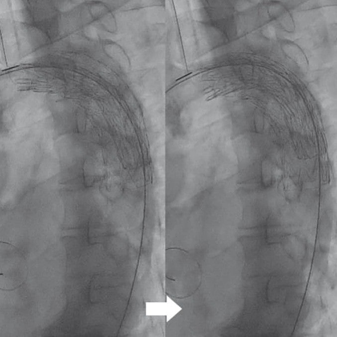 中間径アンギュレーション