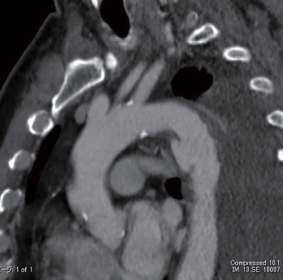 術前 CT サジタル