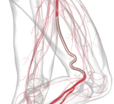 バイアバーン® ステントグラフトの特徴: Endoluminal bypassの役割