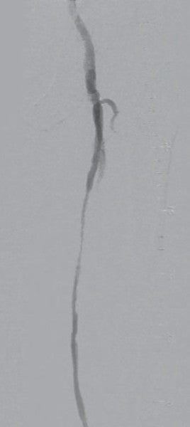 図3 前拡張後DSA画像