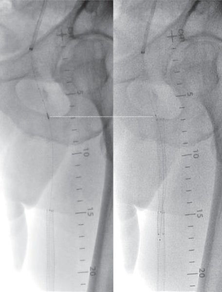 図4 IVUS マーキングとバイアバーン® ステントグラフト近位