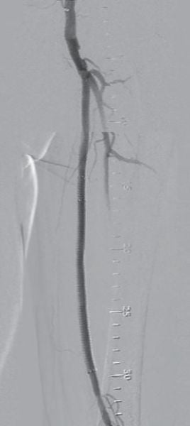 図5 治療後DSA画像