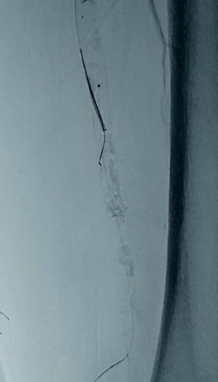 図2 石灰化に弾かれ、retro wireとkissingできない