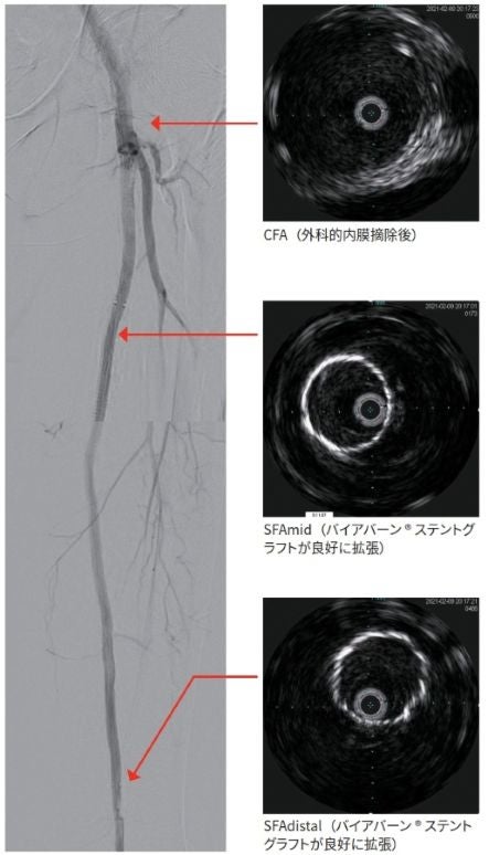図3 アンギオとIVUS にて良好な開存を確認