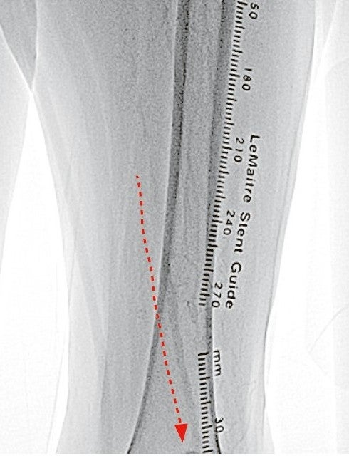 図2 側副路から膝窩動脈が造影され、閉塞長は 20 cm 以上である