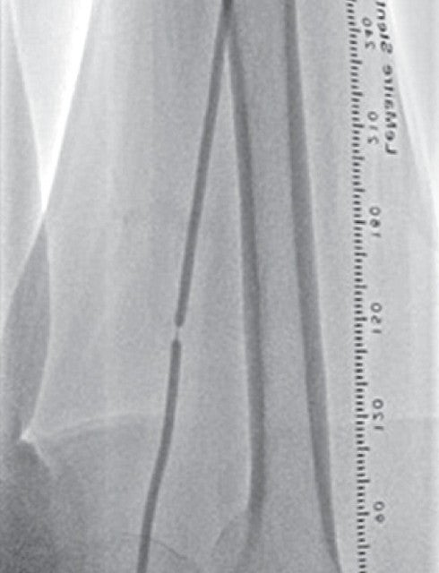 図3 石灰化部位でセミコンプライアントバルーンは拡張不良であった
