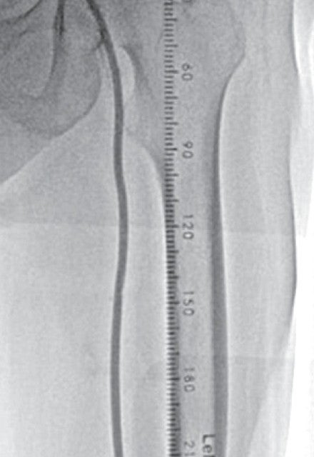 図4 ノンコンプライアントバルーンで石灰化部位を拡張後、250 mmセミコンプライアントバルーンで浅大腿動脈全域を拡張した。