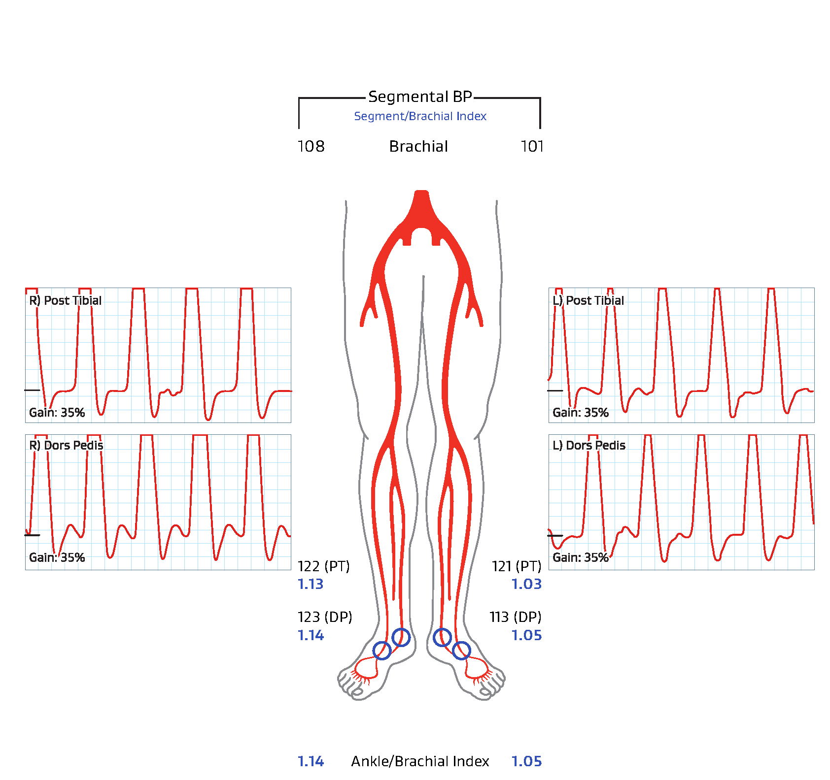 Figure 4. Six-year follow-up ABI. Left = 1.05, Right = 1.14.