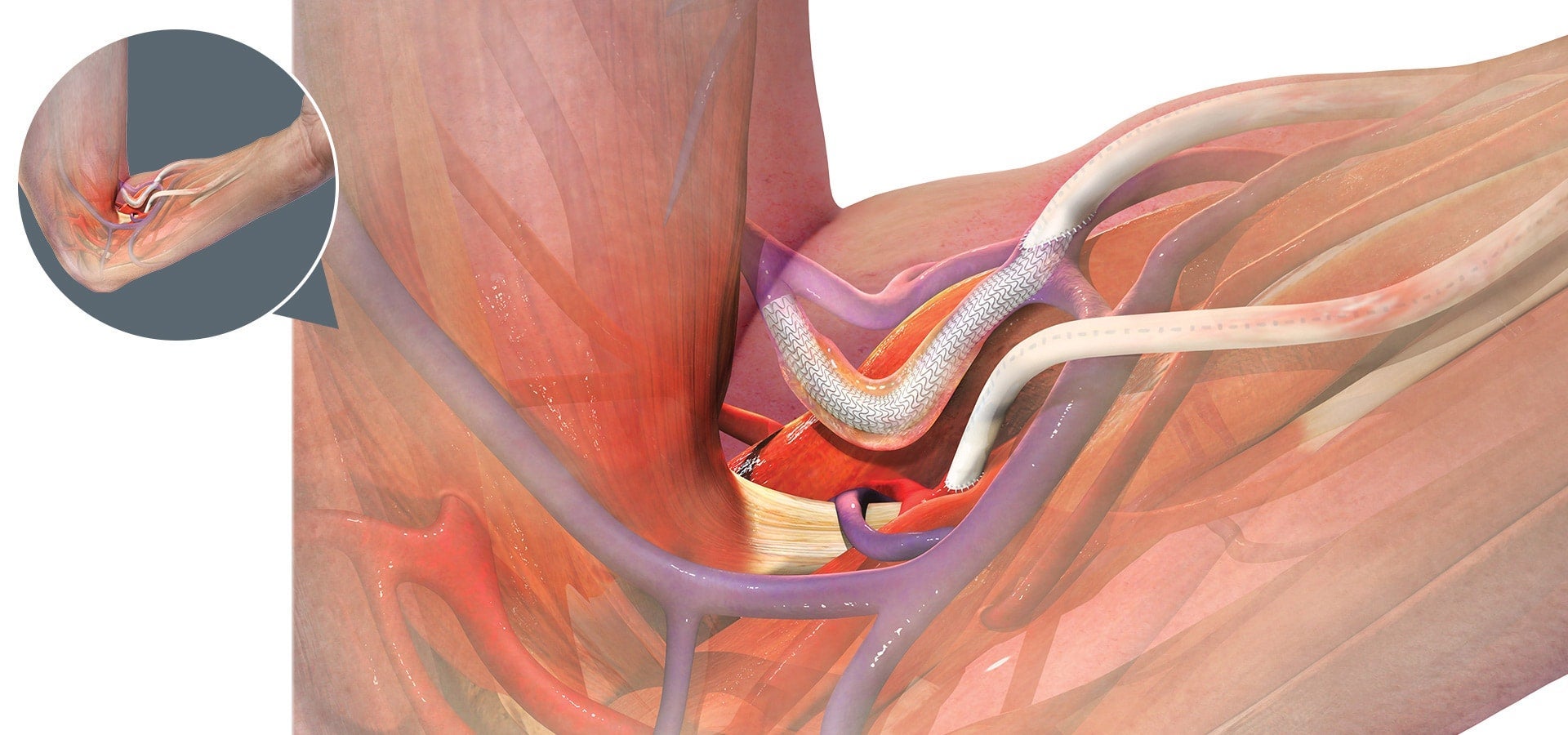 Medical illustration of the upper arm showing an arteriovenous access graft connecting an artery and vein. A white stent graft spans a narrowed section of the graft near the venous connection. Red hotspot markers identify key anatomical locations and device features. An inset image at upper left shows the graft placement within the elbow region from an external perspective.