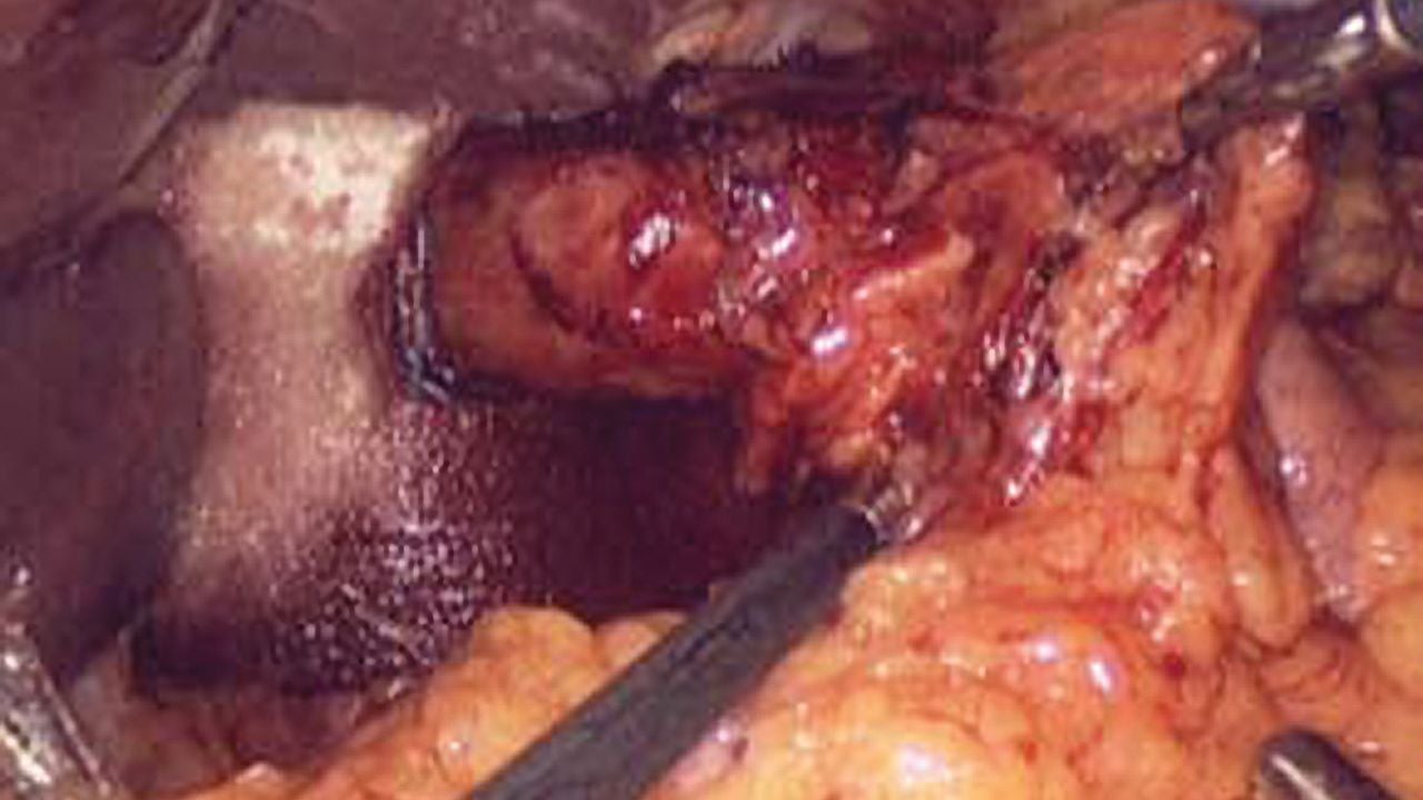 Laparoscopic view of an abdominal surgical procedure showing a biologic graft being positioned inside the abdominal cavity with minimally invasive instruments.