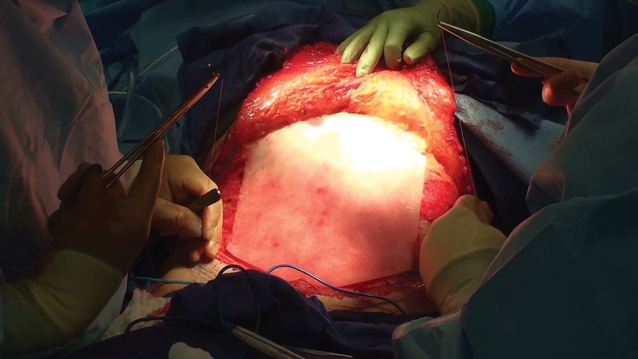 Open abdominal surgery with multiple clinicians positioning a large biologic graft over the abdominal wall before final fixation, with surgical instruments and retractors surrounding the operative field.