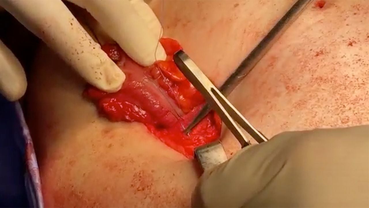 Close-up of an open abdominal surgical incision with gloved hands using forceps to position a thin biologic membrane over exposed tissue during a soft tissue repair procedure.