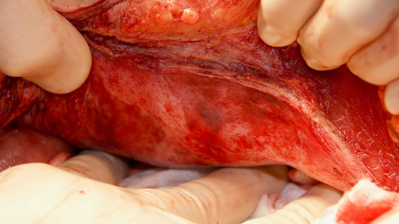 Close-up of an open abdominal incision with gloved hands retracting tissue to expose the abdominal wall during a soft tissue repair procedure. Image courtesy of M.A. Garcia-Urena, MD. Used with permission.