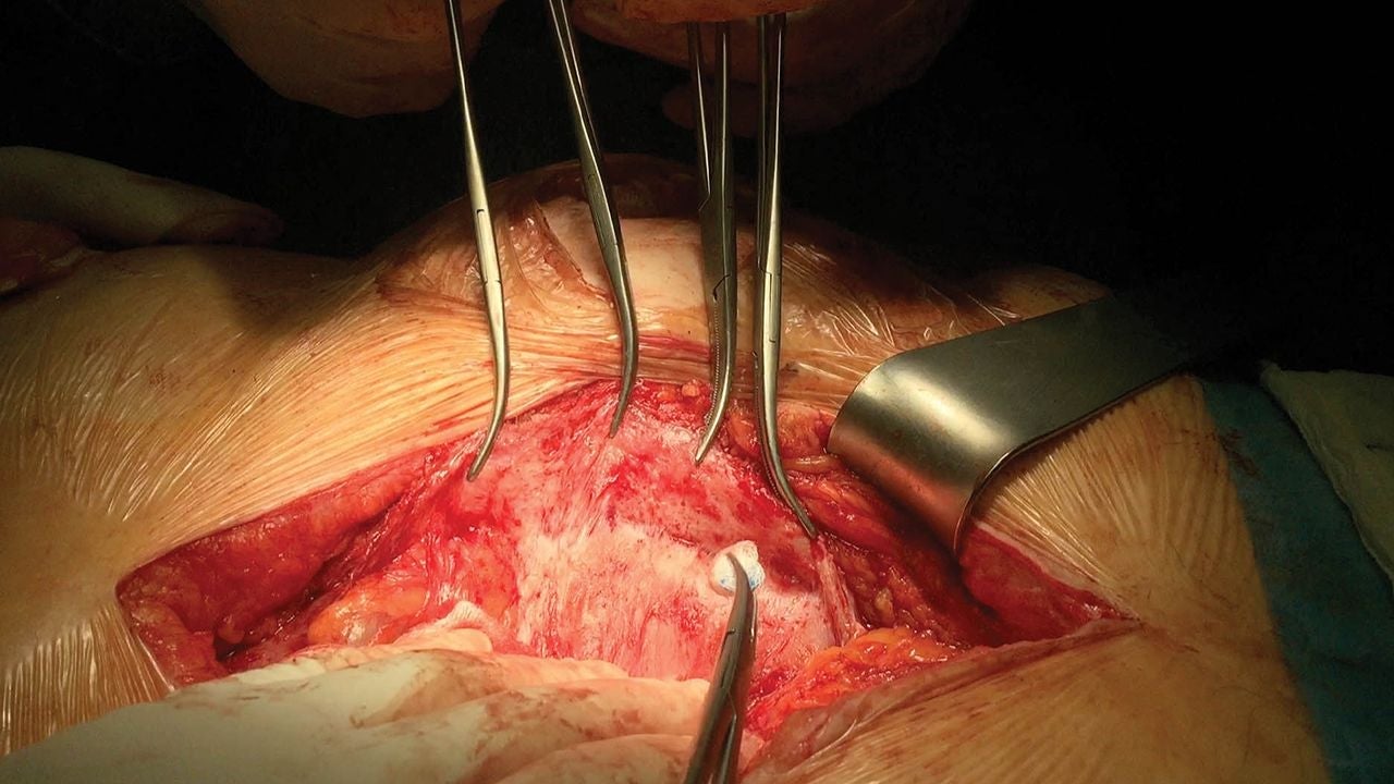 Open abdominal surgery showing a large biologic graft secured over the abdominal wall while surgical retractors and instruments hold the incision open. Image courtesy of M.A. Garcia-Urena, MD. Used with permission.