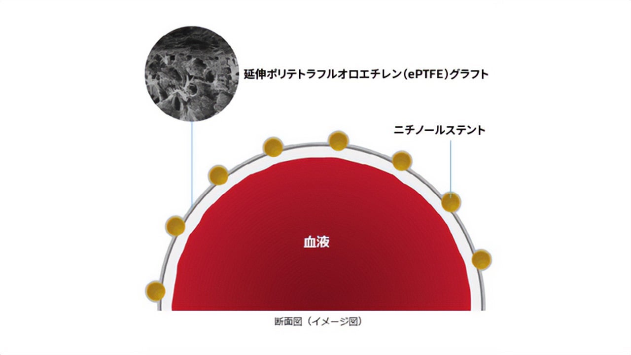 血管内腔の断面イメージ図。赤色で血液を示し、その周囲を延伸ポリテトラフルオロエチレン(ePTFE)グラフトとニチノールステントが覆う構造を示している。