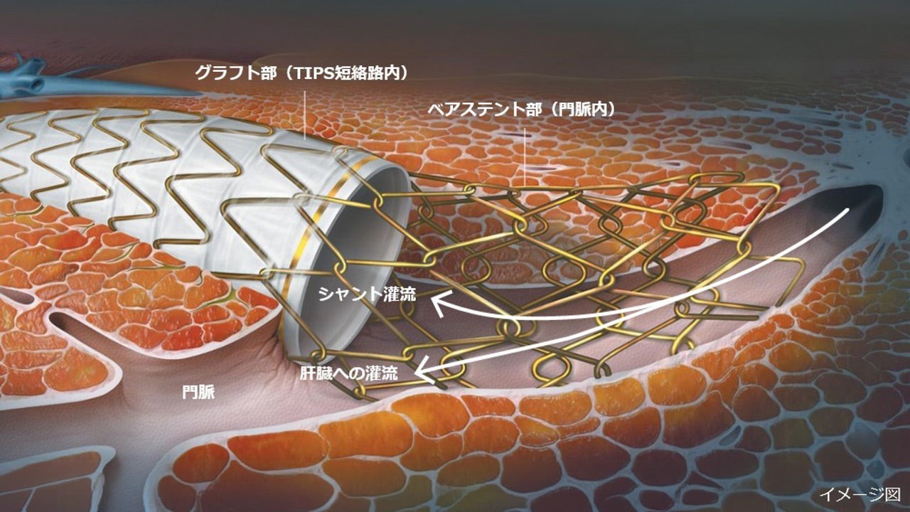 肝臓内に留置されたゴア® VIATORR® TIPSステントグラフト コントロールエクスパンションの医療イラスト。TIPS経路内の被覆グラフトと門脈内のベアステントを示し、矢印でシャントおよび肝臓への血流を示している。