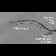 Right brachialaxillary AV graft with stenosis at the venous anastomosis.
