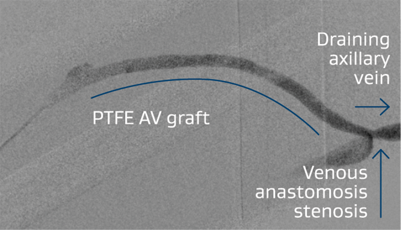 Right brachialaxillary AV graft with stenosis at the venous anastomosis.