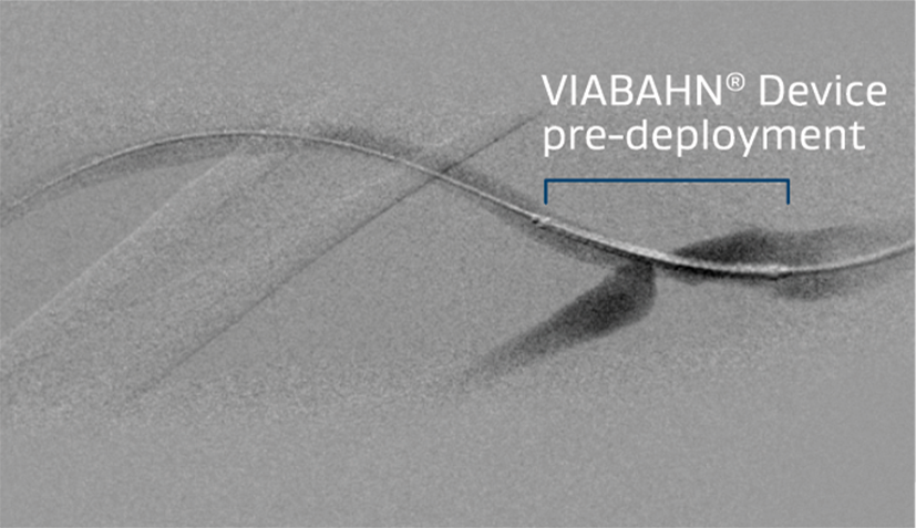 8 x 50 mm GORE® VIABAHN® Endoprosthesis with Heparin Bioactive Surface advanced across the venous anastomosis.