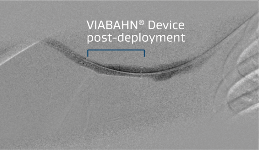 Improved flow and resolution of recoil post VIABAHN® Device placement.