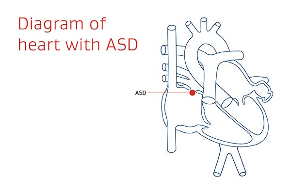 Diagram of the heart with an atrial septal defect (ASD) – a hole in the wall between the heart’s upper chambers.