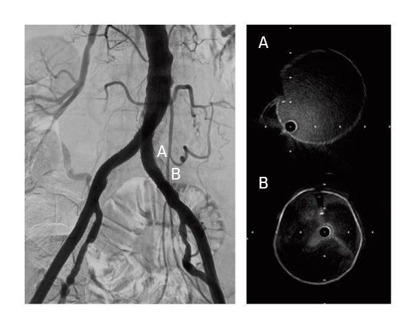 Fully expanded GORE® VIABAHN® VBX Balloon Expandable Endoprosthesis across the calcified segment